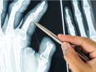 Опасный диагноз «ревматоидный артрит» в практике кистевого хирурга