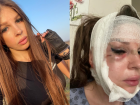 "Дыра в лице": волгоградка показала себя после пластической операции в Баку