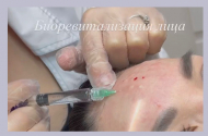Увеличение, коррекция губ. Услуги косметолога - 