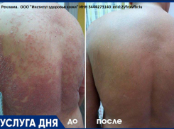 Лечение псориаза  по специальной цене