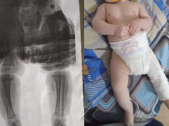 Волгоградка с 4-месячным сыном упала на скользком крыльце поликлиники: у малыша перелом бедра и COVID-19 