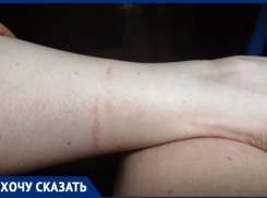 Ожог ноги получила волгоградка после поездки в автобусе №95