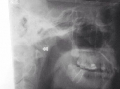 Волгоградец с простреленной головой пешком дошел до больницы 