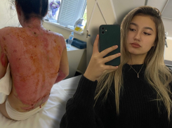 Откровенный рассказ 21-летней красавицы из Волгограда с жуткими ожогами: на девушку рухнул бойлер с кипятком
