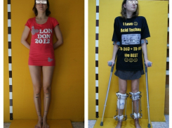  Девушка увеличивает ноги в Волгограде на 18 сантиметров 