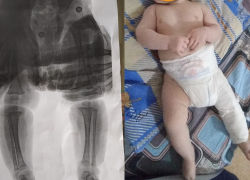 Волгоградка с 4-месячным сыном упала на скользком крыльце поликлиники: у малыша перелом бедра и COVID-19 