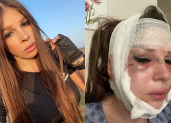 "Дыра в лице": волгоградка показала себя после пластической операции в Баку