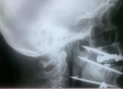 В миллиметре от гибели: волгоградец на рыбалке случайно выстрелил себе в лицо гарпуном 