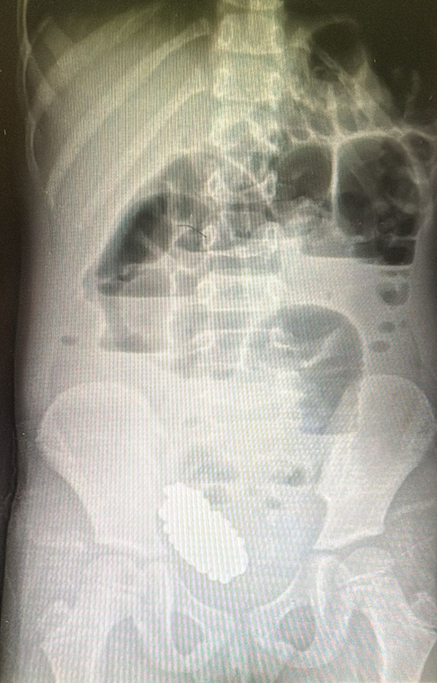 Хирурги извлекли 134 магнитных шарика из живота ребёнка в Волгограде