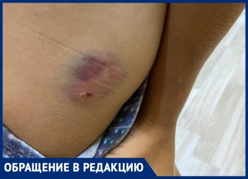 На юге Волгограда собаки покусали 9-летнего мальчика: ребенку колют уколы от бешенства