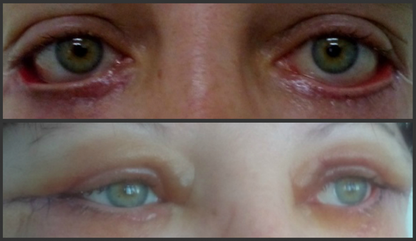 Волжанка стала жертвой пластической хирургии: 1,5 года женщина не могла открыть глаза