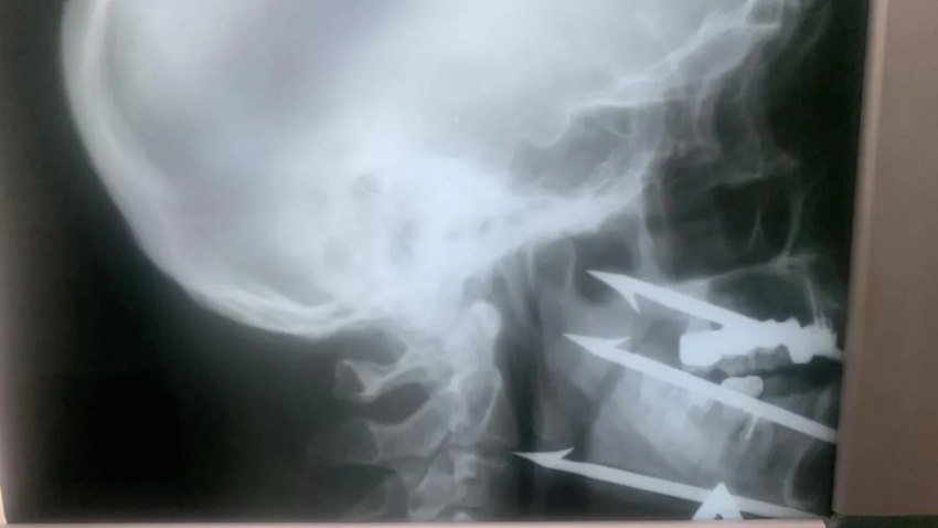 В миллиметре от гибели: волгоградец на рыбалке случайно выстрелил себе в лицо гарпуном 