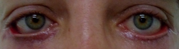 Так выглядели глаза женщины на протяжении 1,5 лет